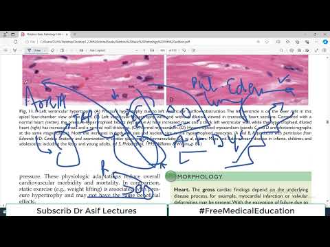 Chp#11 Robbins Patho | Heart Pathology | Left Heart Failure