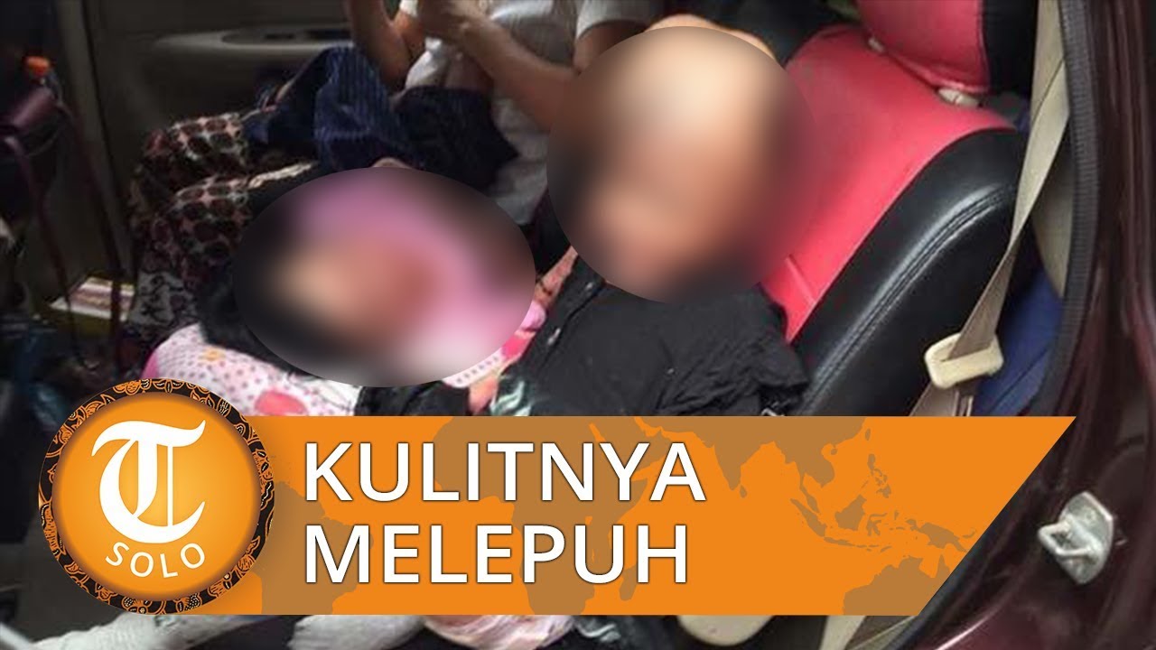 Kisah 2 Bocah Kulitnya Melepuh karena Terkena Panas Kisah 2 Bocah Kulitnya Melepuh karena Terkena Panas