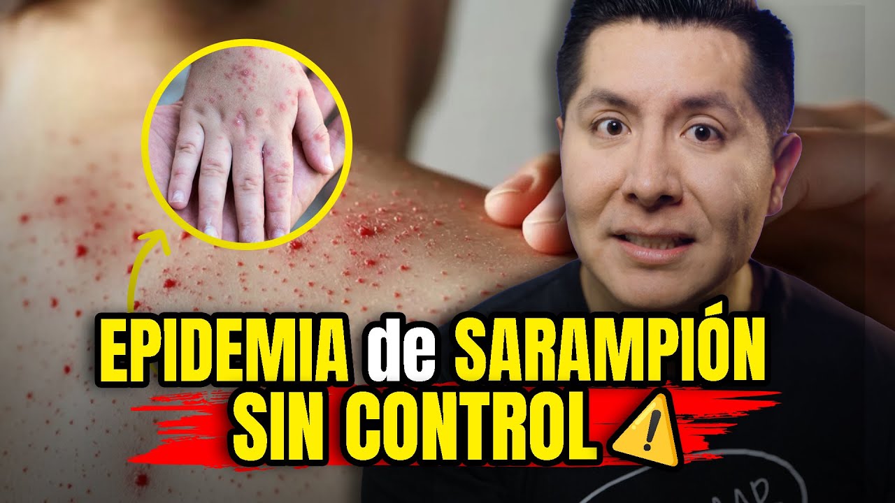 🚨ALERT! MEASLES OUTBREAK in MEXICO 2026: HOW TO PREVENT and TREAT | Mr Doctor