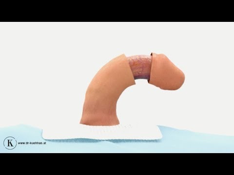 Darsonval Prostatitis Heilung Kräuter Behandlung Gebühren Prostatakrebs