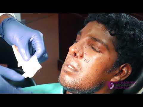Rhinoplasty -Post Surgery Testimonial After 4 Days