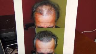 preview picture of video 'Fue Hair Transplant Surgery Result Los Gatos California 1 Yr Follow Up Dr. Diep www.mhtaclinic.com'