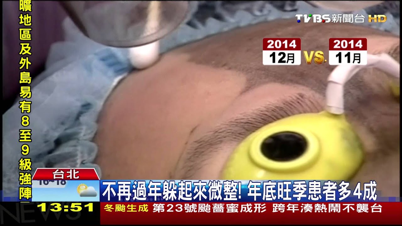 雷射除肝斑太心急 1週打2次反成大花臉