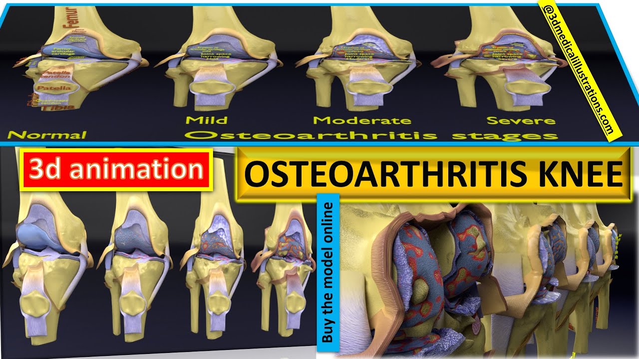 Osteoarthritis stages 3D 3D Model