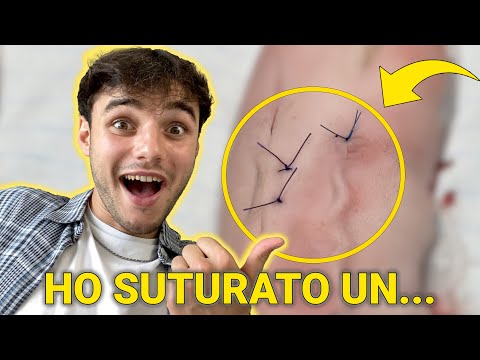 Ho partecipato a un CORSO di SUTURE in ERASMUS