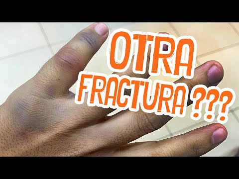 OTRA FRACTURA, no puede ser