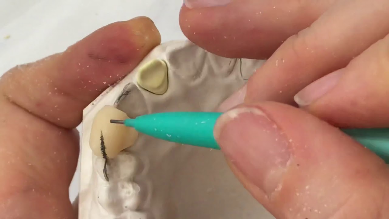 Confecção de coroa provisória(canino) pela técnica da “bolinha”- aula de laboratório