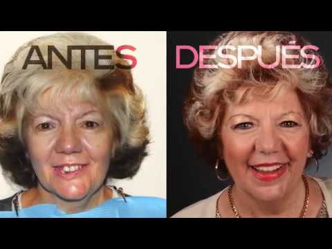 Implantes Dentales – Porcelana