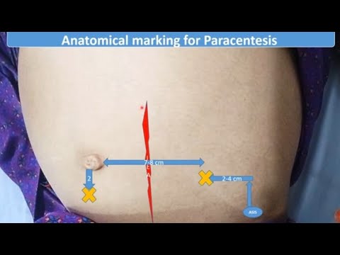 Paracentesis or Ascitic Tap | Pediatrics