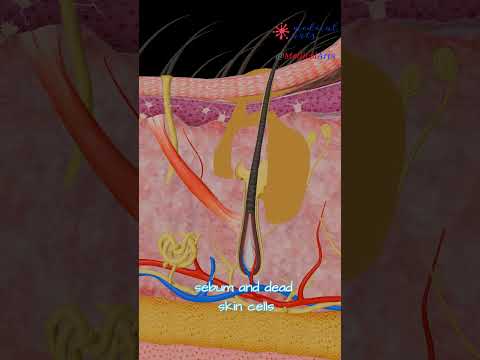 What's inside a pimple? How does acne develop? Medical Arts Animation