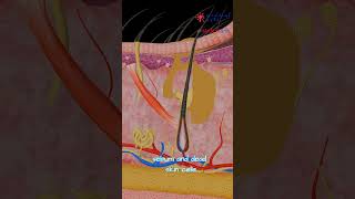 What's inside a pimple? How does acne develop? Medical Arts Animation