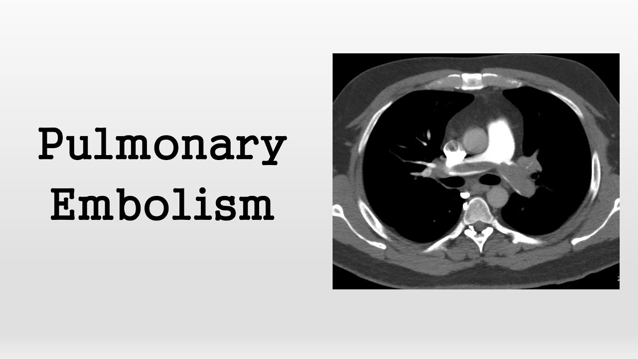 Pulmonary Embolism