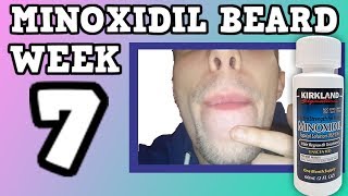 Minoxidil Beard | Week 7 | The Experiment |  #FacialFuzzFridays