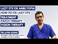 Amblyopia (Lazy Eye) | Meaning | Treatment of Amblyopia (Lazy Eye) | Patch & Vision Therapy Exercise