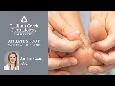 What is athlete's foot and how is it treated?