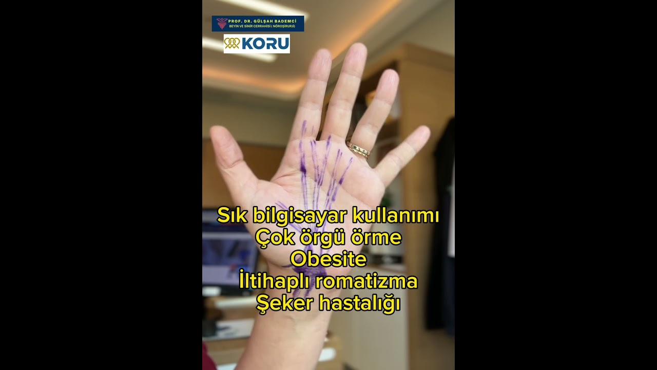 Karpal Tünel Sendromu