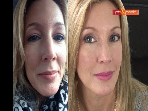 Erase Wrinkles with Injectables! Video