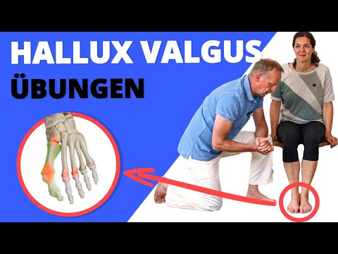 4 exercises for hallux valgus | How to treat it yourself (without surgery!)