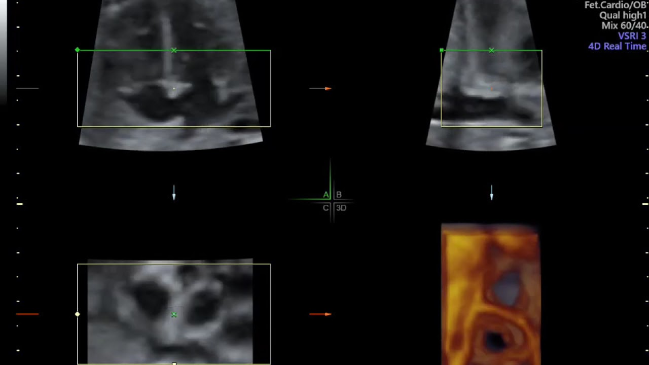 ECOCARDIOGRAFIA FETAL COMFLUXO EM CORES