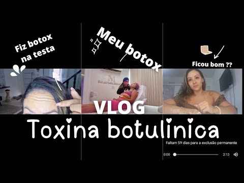 Botox | fiz toxina botulínica na minha testa