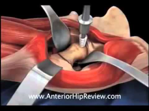 Cómo nadar con osteocondrosis Periartritis de hombro métodos de tratamiento de las articulaciones causa síntomas