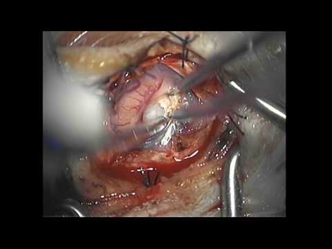 Brain Tumor Microsurgical Resection