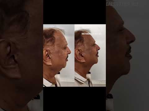 sygmalift Non-Surgical Facelift | Beyond Aesthetics