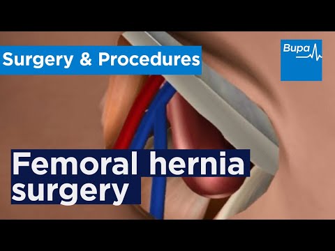 How open femoral hernia surgery is carried out | Bupa Health