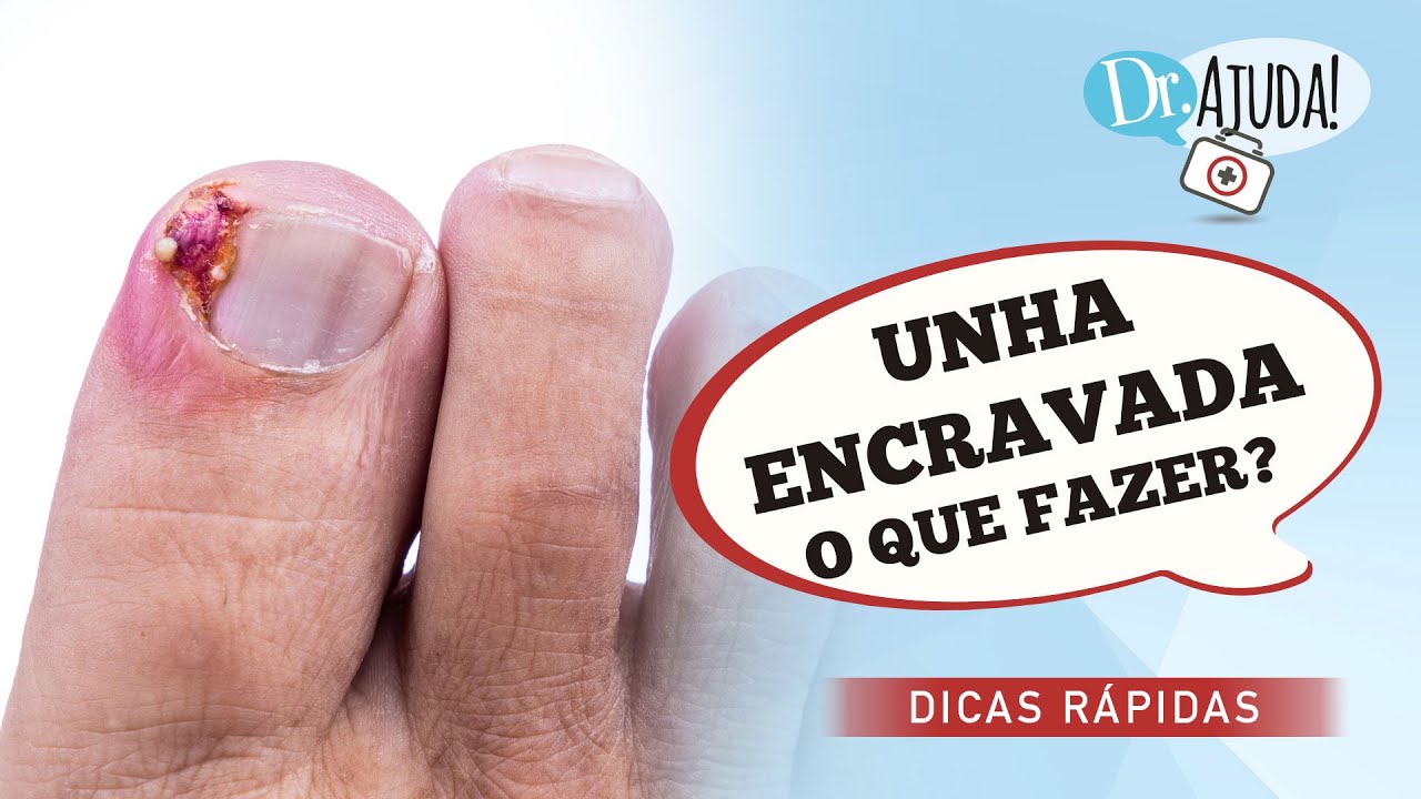 UNHA ENCRAVADA: O QUE FAZER?