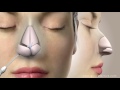 Rhinoplasty (Nose Job) Video Animation - Guncel Ozturk, MD - #DRGO