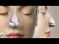 Rhinoplasty Nose Job Video Animation Assoc Prof Dr Guncel Ozturk MD DRGO