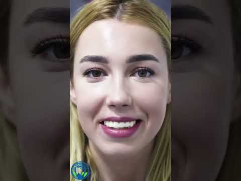Smile Makeover – Before & After Hollywood Smile Transformation #smiledesigndental #smilemakeover