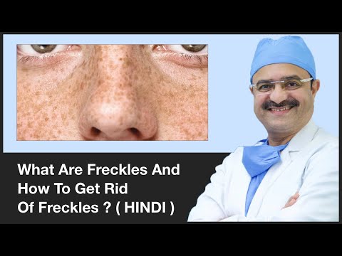 What Are Freckles And How To Get Rid Of Freckles |...