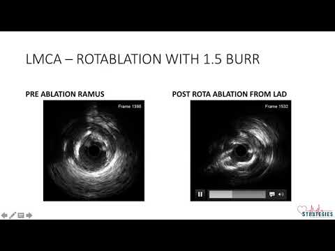 Decoding Complex PCI (1) - IVUS Guided Rotastenting to LMCA Bifurcation