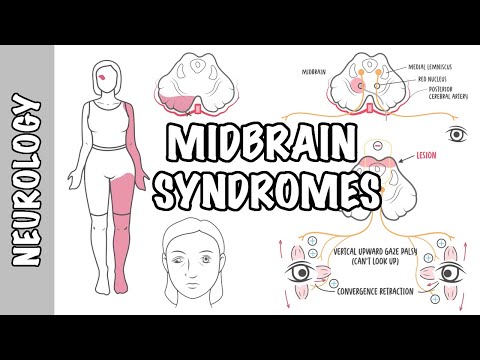 Mittelhirnsyndrome - Weber-Syndrom, Benedikt-Syndrom und Parinaud-Syndrom.