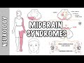Midbrain Syndromes - Weber’s Syndrome, Benedikt’s Syndrome and Parinaud Syndrome.