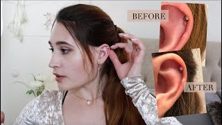 How I Treated My Hypertrophic Scar on Helix Piercing (with photos)