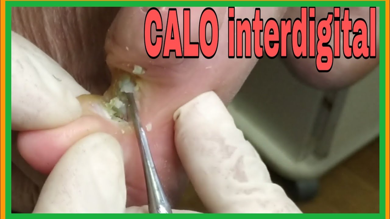 CALO INTERDIGITAL#08
