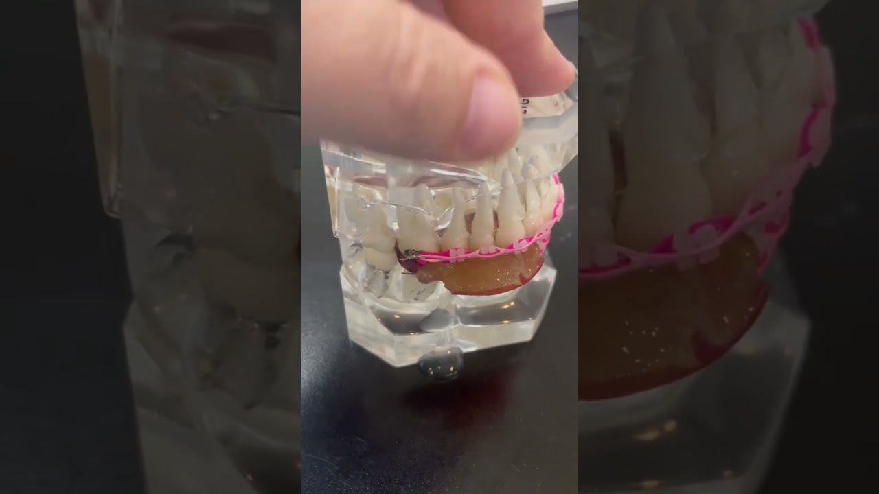 Braces and Grapes Can You Eat Them Together? Fruit Faves