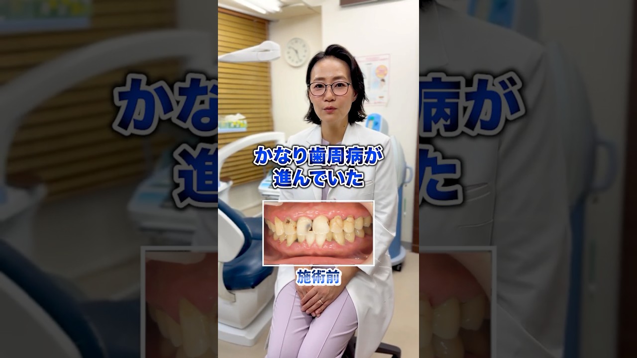 この患者様治せますか？7人目‼️#ザホワイトデンタルクリニック  #歯医者  #虫歯　#歯石除去 #歯石