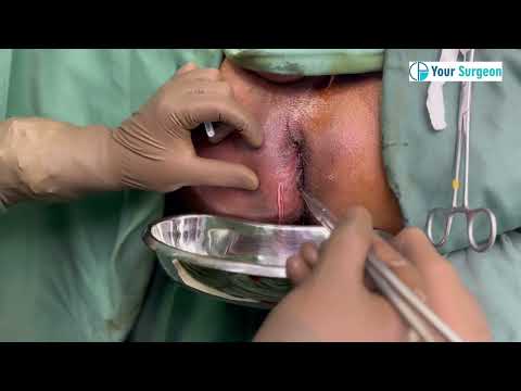 Perianal Abscess - how surgery & operation is done ? Steps for INCISION & DRAINAGE ? Fistulotomy