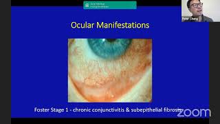 Provided by www.pemphigus.org: Dr  Chang:  New Treatment Strategies for OCP 