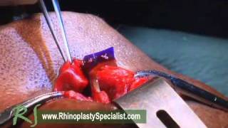 OR Video Footage: PDS Flexible Plate