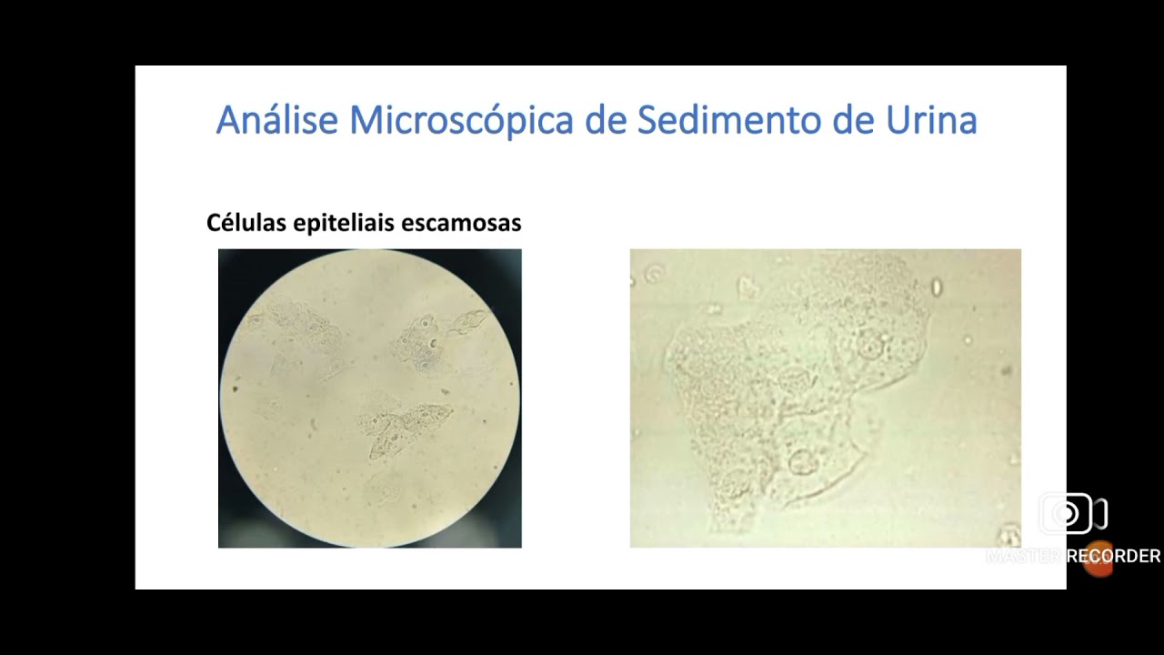 Sedimentoscopia : Análise da urina