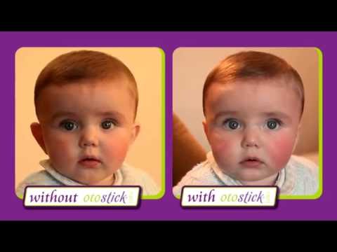 Otostick® Baby aesthetic correctors for protruding ears