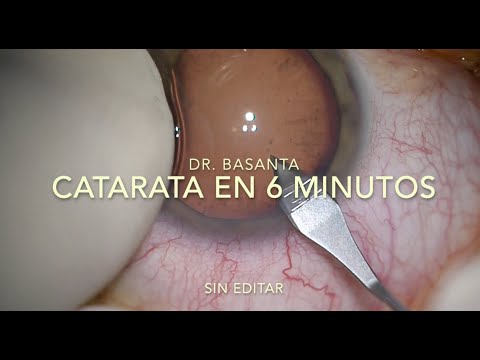 CATARATA EN 6 MINUTOS (sin cortes)