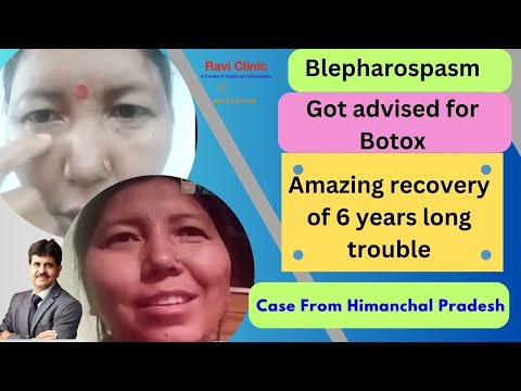 Blepharospasm for years got cured in patient from Himanchal Pradesh Dr Ravi Singh