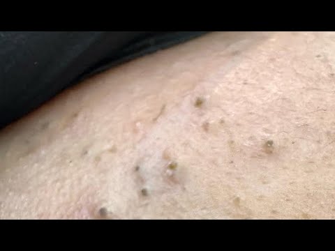 Deep Facial Cleansing | Acne Solutions & Blackhead Removal