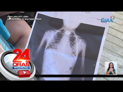 4-anyos na batang lalaki sa Cebu, nakalunok ng P5 barya 24 Oras Weekend