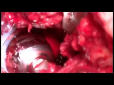 Mal di schiena quando si indossano bambino Problemi con i vasi sanguigni dei sintomi della colonna cervicale